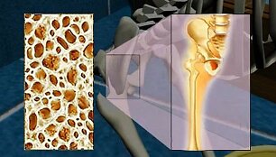 Osteoporozė
