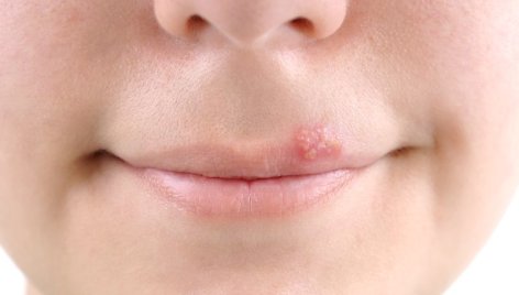 Herpes simplex virusas yra linkęs suaktyvėti žiemos ir pavasario arba vasaros ir rudens periodais.