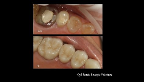 Funkcinės odontologijos pavyzdys