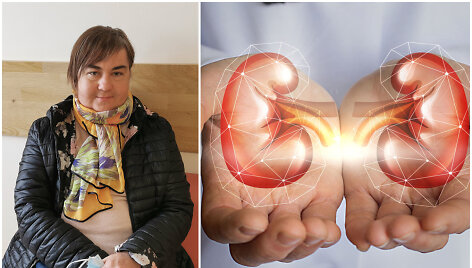 Rūta Ardinavičienė sulaukė kasos ir inksto komplekso transplantacijos
