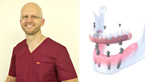 Vakarieti&scaron;ka implantacija Lietuvoje. Kokias metodikas atvežė gydytojas?
