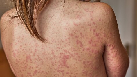 Tymams būdingas bėrimas