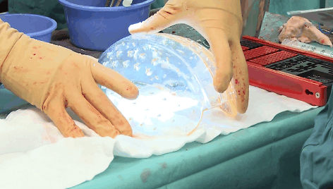 3D spausdintuvu sukurta kaukolė pirmą kartą persodinta pacientei