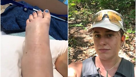 Turistės i&scaron;gelbėjimas po nuodingos gyvatės įkandimo
