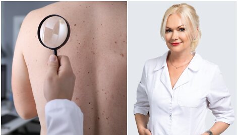 Dermatovenerologė Inga Valavičienė &ndash; apie įvairiaspalvę dedervinę