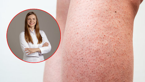 Gydytoja dermatologė Aurėja Kontrimienė pataria, kaip išvengti braškinės odos