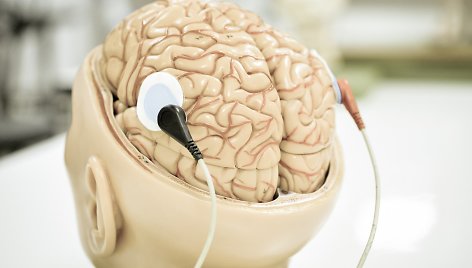 Smegenų implantas