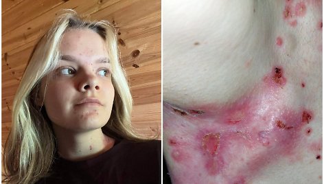 Reta liga serganti 17-metė Ramunė – apie žaizdomis nusėtą odą, patyčias ir praeivių žvilgsnius