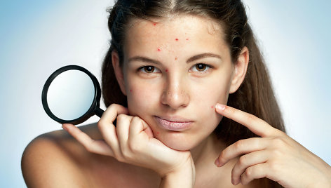 Kovoje su akne: kosmetologės patarimai, padėsiantys pagerinti odos būklę
