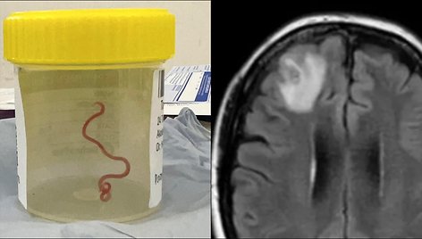 Smegenyse pastebėta gyva kirmelė