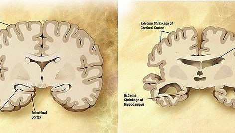 Smegenys ir Alzheimerio liga