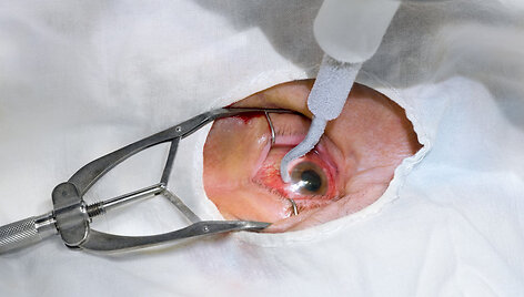 Akių ligos (asociatyvinė nuotr.)