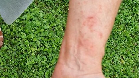 Klebonas Robertas Gedvydas Skrinskas pasidalino ir nuotraukomis, kaip atrodo jo rankos ir kojos