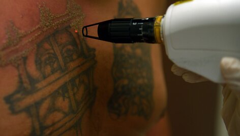 Salvadoro gaujų nariai naikina gaujų priklausomybę žyminčias tatuiruotes, kad pradėtų gyvenimą i&scaron; naujo