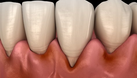 Neskausmingas simptomas, į kurį dažnai numojame ranka: atsainumo pasekmė – dantų netekimas