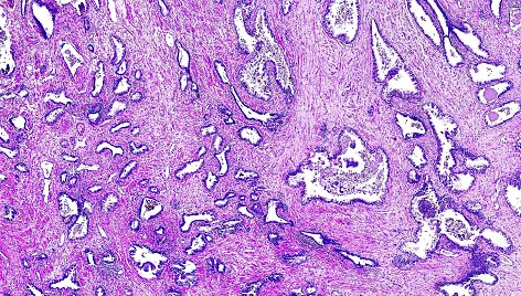 Žmogaus prostatos vėžio histologinis vaizdas