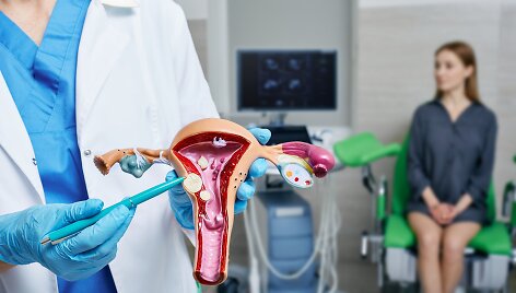 Gimdos miomos ir polipai