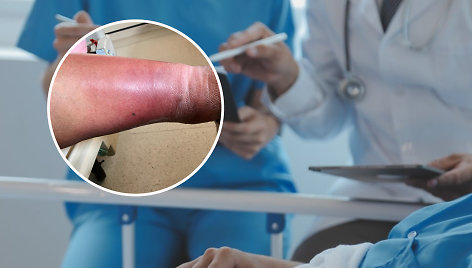 Atostogų metu moteris pasigavo celiulito infekciją