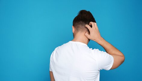Dermatologė papasakojo apie seborėjinį dermatitą: kalbėjimas apie pleiskanas neturėtų būti tabu