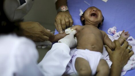 Brazilijoje dėl Zika viruso mikrocefalija sergantis kūdikis