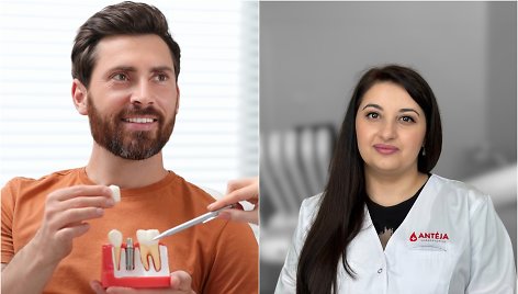 Dantų implantavimas / Burnos chirurgė Narine Sarukhanyan
