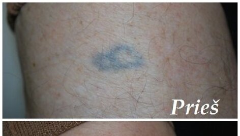 Tatuiruočių &scaron;alinimas lazeriu