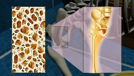 Osteoporozė