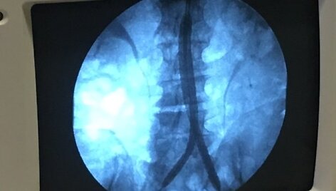 Aortos aneurizmos operacija