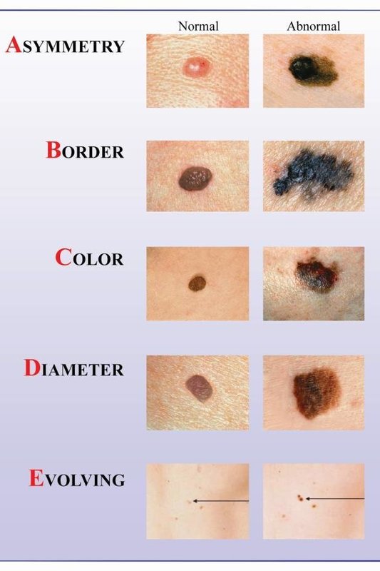 Melanoma: kaip atpažinti pavojingus apgamus?