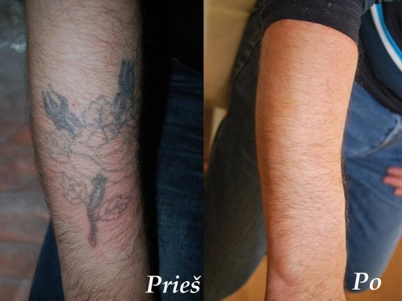 Modus Studio Photo / Laser Tattoo Removal