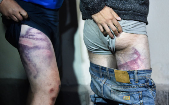 AFP / Scanpix Photo / Detainees show bruises