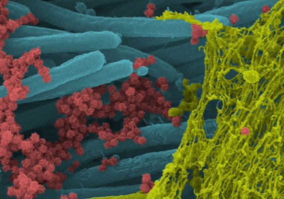 Photo by C. Ehre / SARS-CoV-2 virions attack lung cells