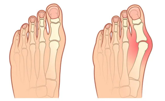 Dr. Foot Podiatry Clinic nuotr./Hallux valgus deformacija