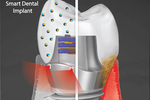 Albert Kim, Templio universitetas/Išmanusis dantų implantas galėtų patobulinti dabartinius prietaisus, nes jame būtų panaudotos biologinei plėvelei atsparios nanodalelės