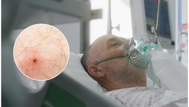 Gydytojai skelbia nerimą keliančią statistiką: daugėja sunkių erkinio encefalito atvejų, yra ir mirčių