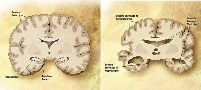 Wikimedia Commons iliustr./Smegenys ir Alzheimerio liga