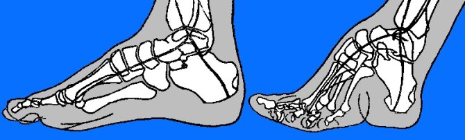 wikimedia.org nuotr./Kairėje – įprasta pėda, dešinėje – deformuota pėda