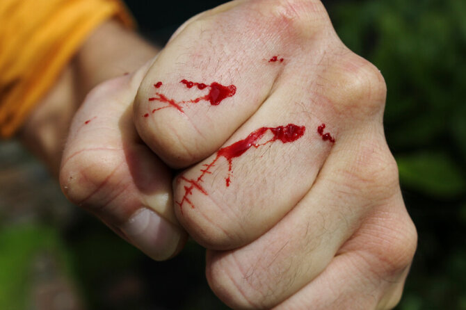 Shutterstock nuotr./Trauma