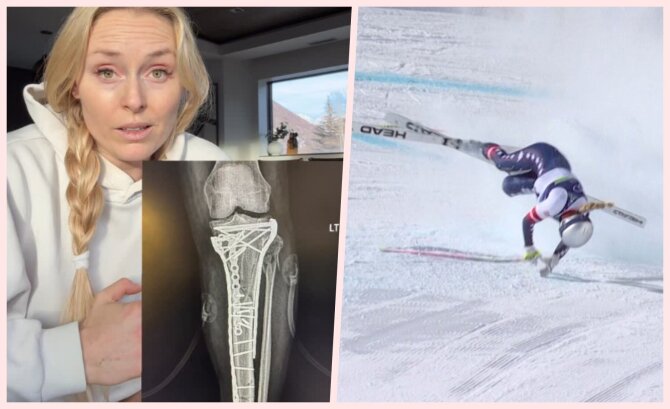 Scanpix ir instagramo nuotr./Lindsey Vonn sveiksta po siaubingo kritimo Milano-Kortinos žaidynėse.