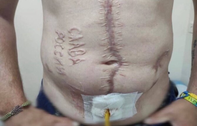 Nuotr. iš socialinių tinklų/Nuotrauka, kurioje matyti iš Rusijos nelaisvės grįžęs Ukrainos kariškis su ant pilvo išraižytu užrašu „Šlovė Rusijai“