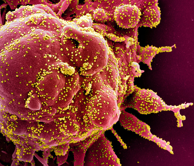 „Reuters“/„Scanpix“ nuotr./Mirštanti žmogaus ląstelė, kurioje prisigamino daugybė koronaviruso kūnelių (virusas – geltoni taškeliai)