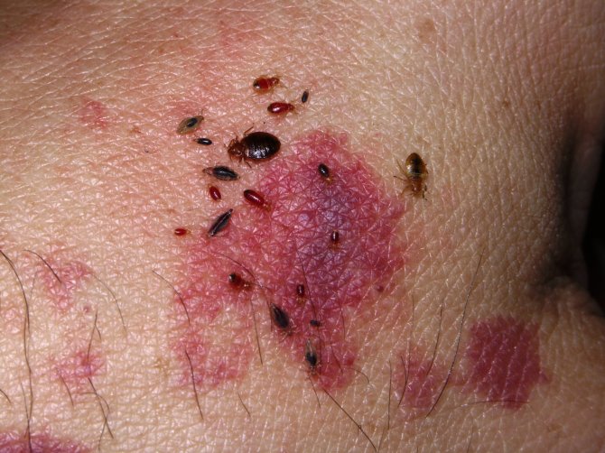 Patalynės blakių įkandimai dažnai painiojami su alergine reakcija.