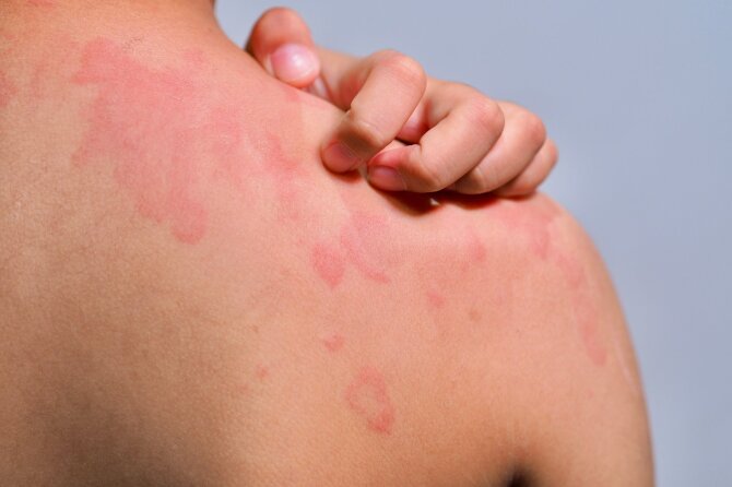 Shutterstock nuotr./Alergija