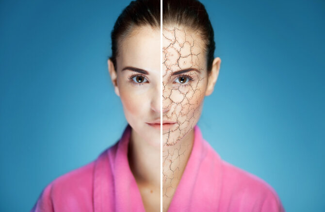 „Fotolia“ nuotr./Išsausėjusi oda