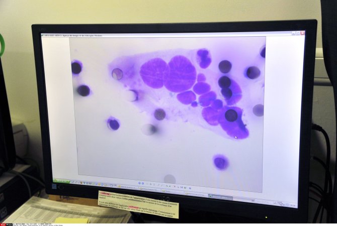 Scanpix nuotr./Vėžio ląstelės kompiuterio ekrane