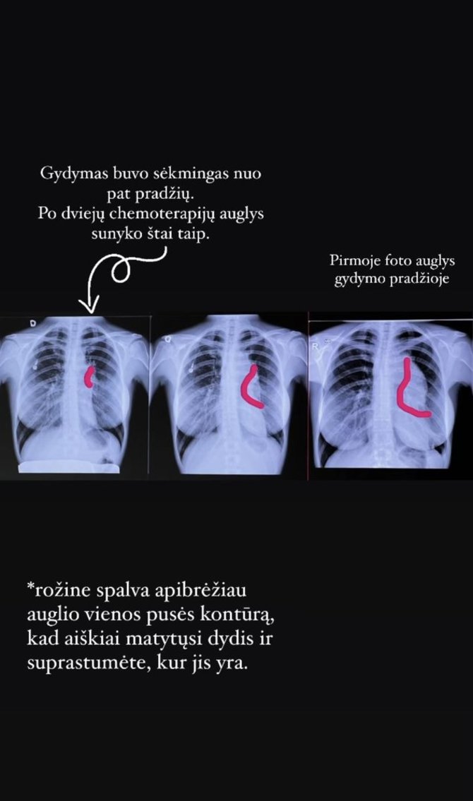 Socialinių tinklų nuotr./Indrė Burlinskaitė-Vaisieta parodė, kaip nyko auglys jos krūtinėje