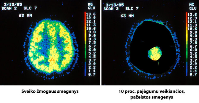 Šiaurės Karolinos (JAV) universisteto duomenų bazės nuotr./Sveikų ir pažeistų smegenų palyginimas 