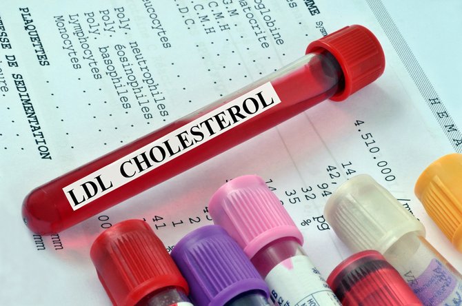 Shutterstock nuotr./Cholesterolis