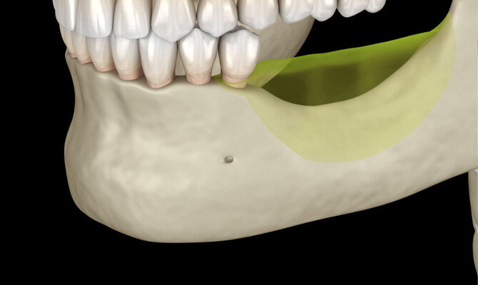 „Dentvalda“ nuotr./Dantų implantacija šiandien: nuo mitų iki sprendimo, kuris pakeičia gyvenimo kokybę