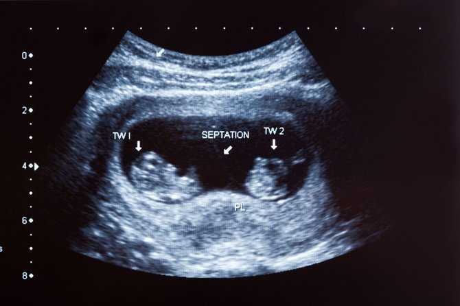 123 RF.com nuotr./10 mėnesių dvynių įprastinis nėštumas